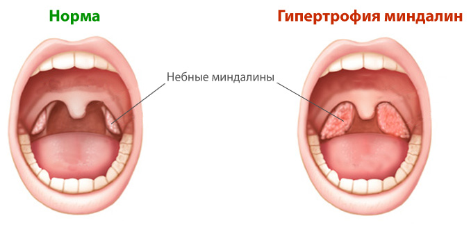Гипертрофия небных миндалин